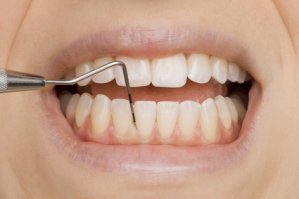 Q10 e óleo de melaleuca são eficazes contra a doença periodontal