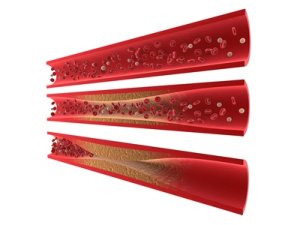 The figure shows the development of atherosclerosis in a coronary artery and how the oxidized cholesterol is embedded in the vessel wall